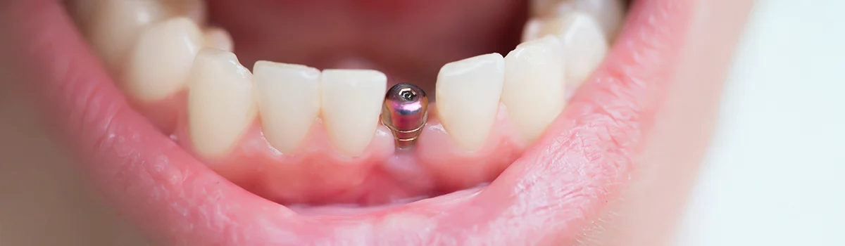 Chirurgie et implants dentaires - Dentiste Paris 9