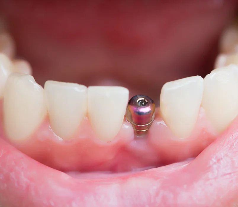Chirurgie dentaire & Implantologie